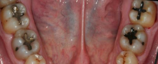 Periodontitis, estadio II, grado A